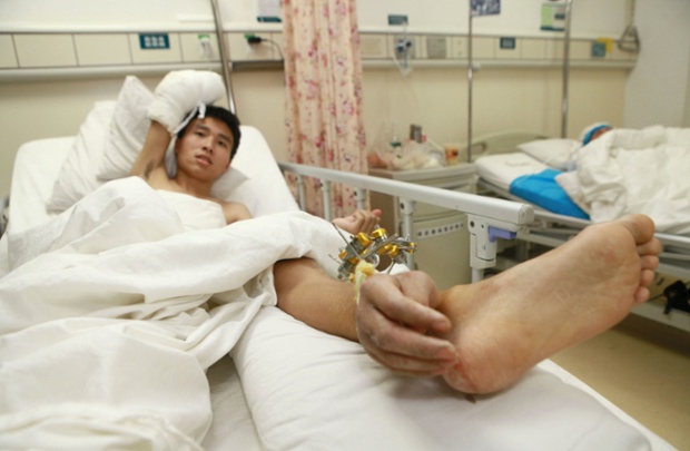 Man has severed hand attached to leg to keep it alive, Changsha, Hunan Province, China - 10 Dec 2013